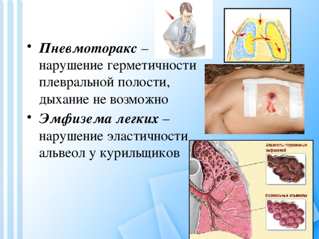 Пневмоторакс – нарушение герметичности плевральной полости, дыхание не возможно Эмфизема легких – нарушение эластичности альвеол у курильщиков 