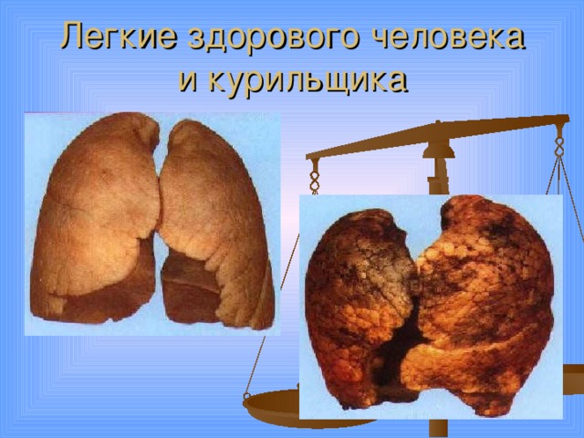 Легкие здорового человека  и курильщика 