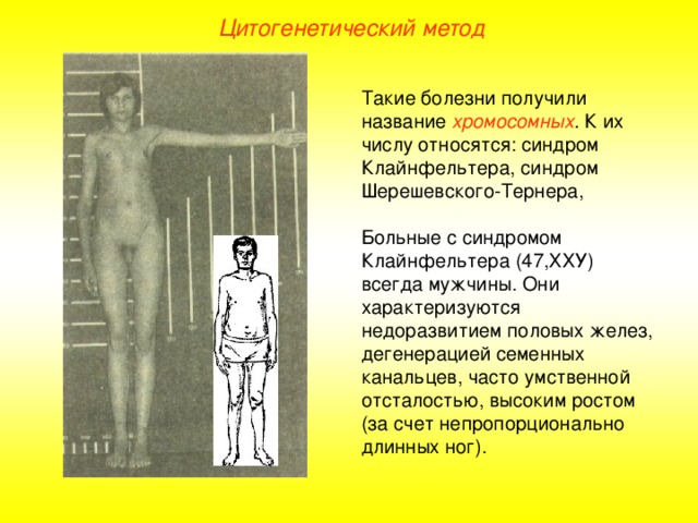 Цитогенетический метод Такие болезни получили название хромосомных . К их числу относятся: синдром Клайнфельтера, синдром Шерешевского-Тернера, Больные с синдромом Клайнфельтера (47,ХХУ) всегда мужчины. Они характеризуются недоразвитием половых желез, дегенерацией семенных канальцев, часто умственной отсталостью, высоким ростом (за счет непропорционально длинных ног).  