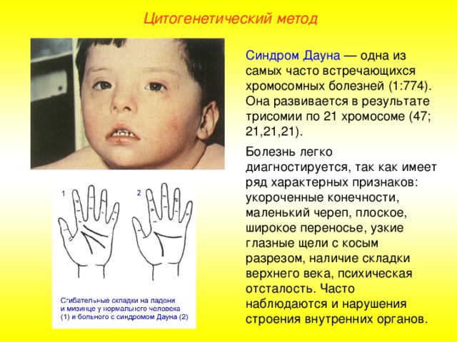Цитогенетический метод Синдром Дауна — одна из самых часто встречающихся хромосомных болезней (1:774). Она развивается в результате трисомии по 21 хромосоме (47; 21,21,21). Болезнь легко диагностируется, так как имеет ряд характерных признаков: укороченные конечности, маленький череп, плоское, широкое переносье, узкие глазные щели с косым разрезом, наличие складки верхнего века, психическая отсталость. Часто наблюдаются и нарушения строения внутренних органов.  