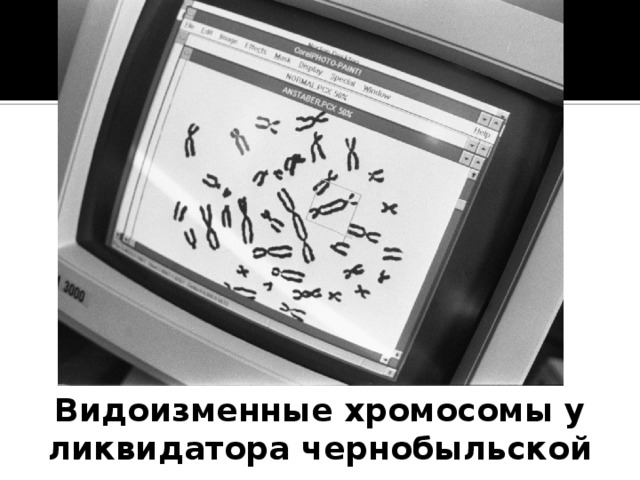 Видоизменные хромосомы у ликвидатора чернобыльской аварии.  