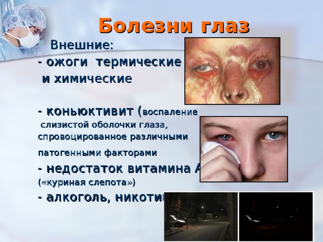 Болезни глаз Внешние: - ожоги термические  и химические - коньюктивит ( воспаление  слизистой оболочки глаза, спровоцированное различными патогенными факторами  - недостаток витамина А («куриная слепота») - алкоголь, никотин 