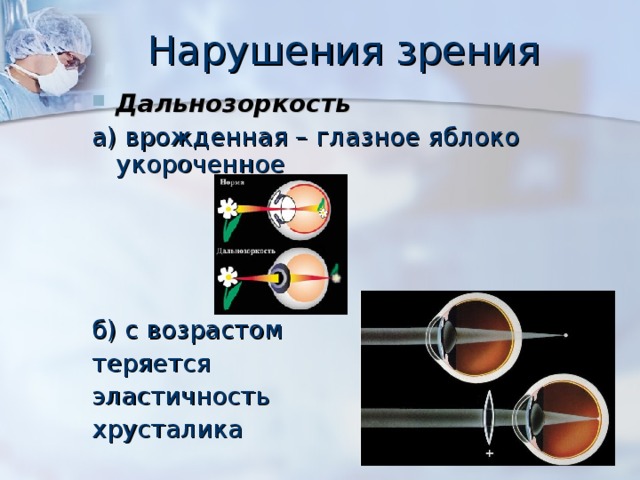 Нарушения зрения Дальнозоркость а) врожденная – глазное яблоко укороченное б) с возрастом теряется эластичность хрусталика 