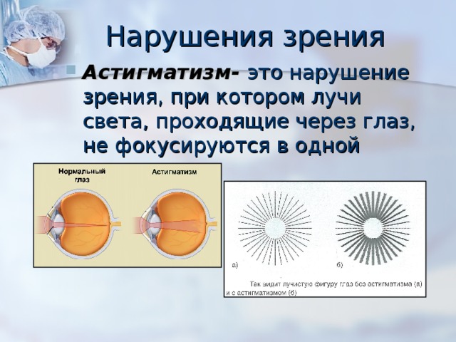 Нарушения зрения Астигматизм- это нарушение зрения, при котором лучи света, проходящие через глаз, не фокусируются в одной точке 