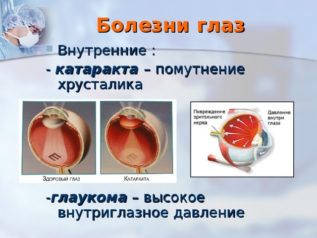 Болезни глаз Внутренние : - катаракта – помутнение хрусталика - глаукома – высокое внутриглазное давление 
