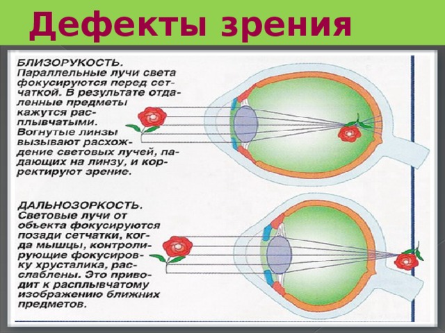 Дефекты зрения 