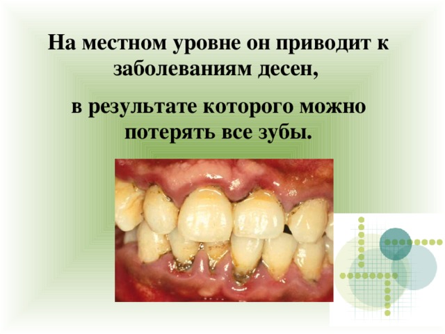 На местном уровне он приводит к заболеваниям десен, в результате которого можно потерять все зубы.  