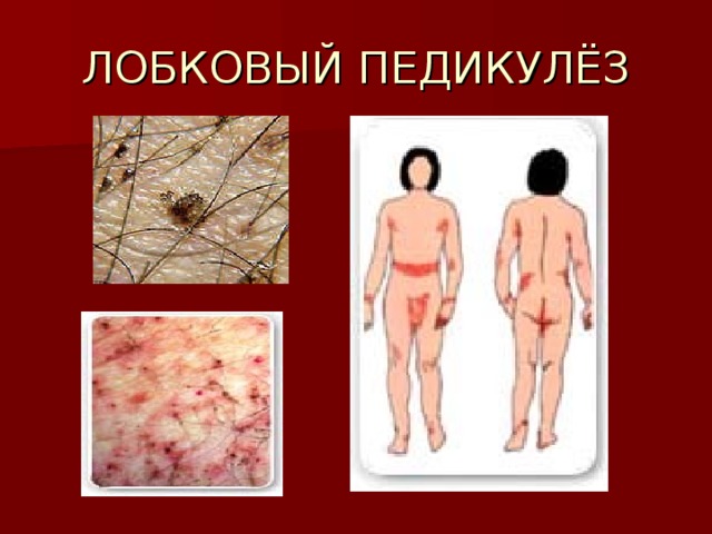 ЛОБКОВЫЙ ПЕДИКУЛЁЗ 
