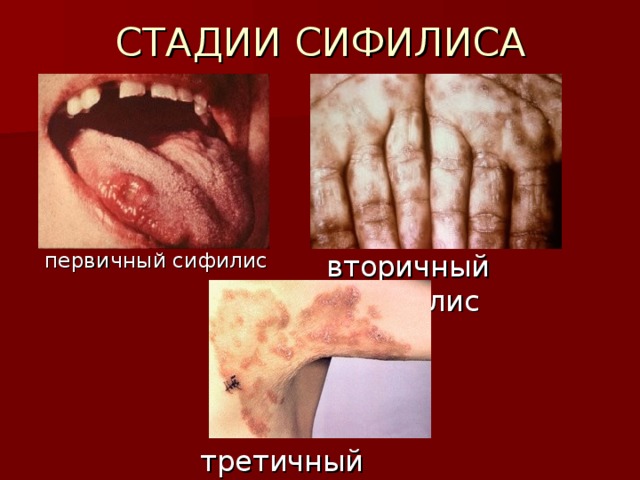 СТАДИИ СИФИЛИСА первичный сифилис вторичный сифилис третичный сифилис 