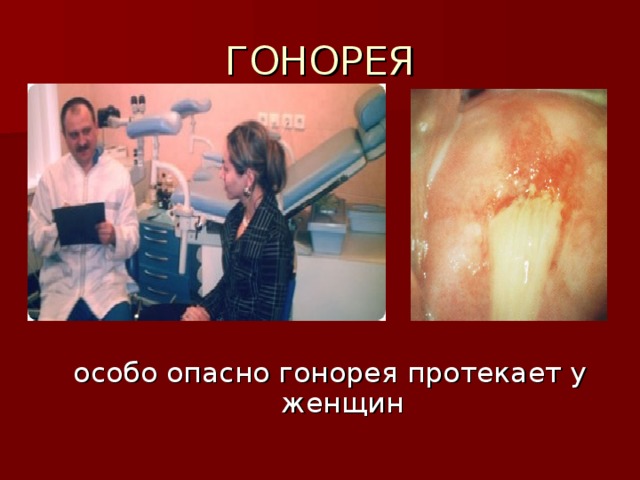 ГОНОРЕЯ особо опасно гонорея протекает у женщин 