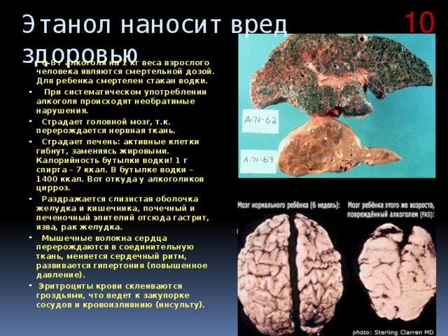 10 Этанол наносит вред здоровью  6-8 г алкоголя на 1 кг веса взрослого человека являются смертельной дозой. Для ребенка смертелен стакан водки.  При систематическом употреблении алкоголя происходят необратимые нарушения.  Страдает головной мозг, т.к. перерождается нервная ткань.  Страдает печень: активные клетки гибнут, заменяясь жировыми. Калорийность бутылки водки! 1 г спирта – 7 ккал. В бутылке водки – 1400 ккал. Вот откуда у алкоголиков цирроз.  Раздражается слизистая оболочка желудка и кишечника, почечный и печеночный эпителий отсюда гастрит, язва, рак желудка.  Мышечные волокна сердца перерождаются в соединительную ткань, меняется сердечный ритм, развивается гипертония (повышенное давление).  Эритроциты крови склеиваются гроздьями, что ведет к закупорке сосудов и кровоизлиянию (инсульту). Печень алкоголика и здорового человека 
