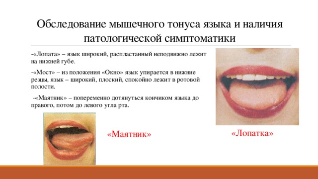 Обследование мышечного тонуса языка и наличия патологической симптоматики -«Лопата» – язык широкий, распластанный неподвижно лежит на нижней губе. -«Мост» – из положения «Окно» язык упирается в нижние резцы, язык – широкий, плоский, спокойно лежит в ротовой полости.   -«Маятник» – попеременно дотянуться кончиком языка до правого, потом до левого угла рта. «Лопатка» «Маятник» 